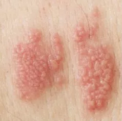 genital herpes genital herpes